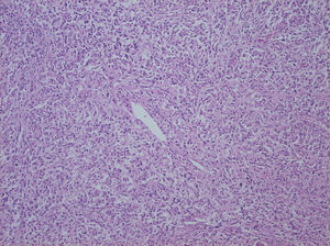 Histiocitos de amplio citoplasma eosinófilo con gránulos PAS-positivos y núcleo central, compatibles con malacoplaquia.