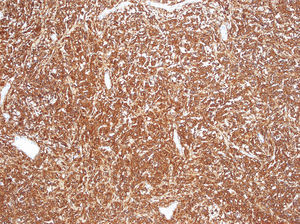 Tejido intensamente positivo a tinción inmunohistoquímica para CD20, mostrando un linfoma B difuso de célula grande.