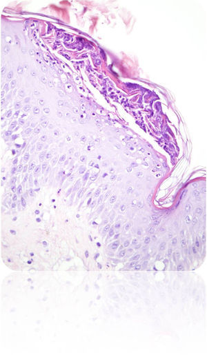 Espongiosis con abscesos neutrofílicos en capa superficial (abscesos de Kogoj).
