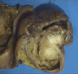 Pieza macroscópica de intestino con región blanquecina, correspondiente a endometriosis intestinal.