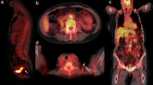 Estudio PET/TC con 18F-FDG. Las imágenes de fusión PET/TC muestran captación patológica en el tumor primario (a, flecha), en una adenopatía inter-aorto-cava (b, c) y en una adenopatía supraclavicular izquierda (d, flecha)