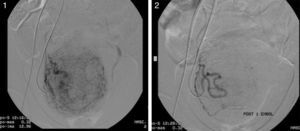 Se aprecia en la imagen 1 la vascularización del mioma uterino y en la imagen 2 el control postembolización demostrando la devascularización total del tumor.