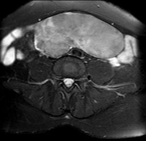 RMN: tumor sólido abdominal.