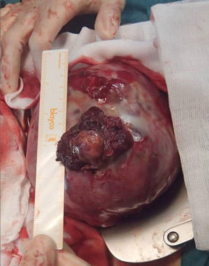 Focos de placenta pércreta en fondo uterino.