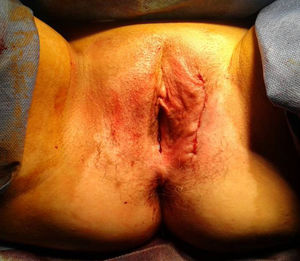 Área perineal tras la exéresis tumoral.