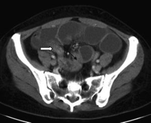 CT abdominal donde se observa dilatación de asas de intestino delgado, y cambio de calibre a nivel de íleon distal (flecha negra), a unos 10cm de la válvula ileocecal (flecha blanca).