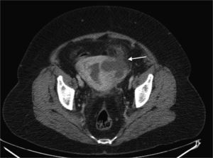 Imagen de TC en el plano axial tras la administración de medio de contraste a nivel pélvico evidenciando dilatación de la cavidad uterina y presencia de una colección parauterina izquierda e infiltración de los planos grasos adyacentes (flecha).