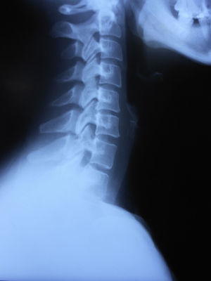 Radiografía cervical que muestra la artrosis que padecía la paciente.