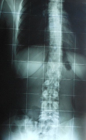 La radiografía muestra la escoliosis que presentaba la paciente.