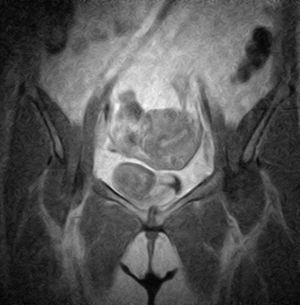 Angioleiomioma uterino. Imagen ocupante de espacio a nivel de fondo uterino. Resonancia magnética nuclear.