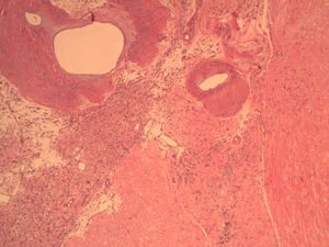 Angioleiomioma uterino. En la imagen microscópica se observan gruesos fascículos musculares en relación con vasos hiperplásicos con paredes gruesas junto a los que destaca un segundo componente microvascular delicado. HE 40x.