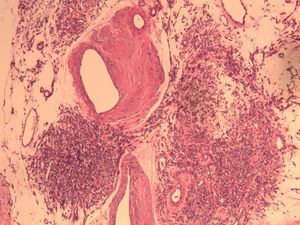 Angioleiomioma uterino. En la imagen microscópica se observan con detalle áreas en las que predomina el componente macrovascular, microvascular y un patrón mixto. HE 100x.