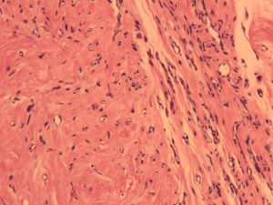Angioleiomioma uterino. En la imagen microscópica se aprecia cómo pequeños vasos capilares organizados en lobulillos o penachos (patrón microvascular) penetran en el seno del tejido muscular. HE 200x.