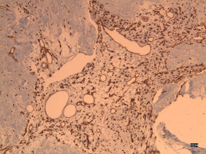 Angioleiomioma uterino. Con técnicas inmunohistoquímicas (CD34) se ponen de manifiesto los vasos proliferantes y se destacan sus características arquitecturales. CD34 100x.
