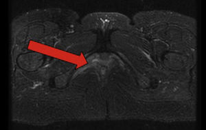 Resonancia magnética que muestra cambios fibrocicatriciales en la fosa isquiorrectal derecha en relación con desgarro perineal previo. Se objetiva una hiperseñal en secuencias STIR en la localización teórica del canal de Alcock compatible con la orientación diagnóstica de atrapamiento del nervio pudendo derecho.