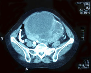 TC abdómino-pélvica, informada como cistoadenocarcinoma de ovario.
