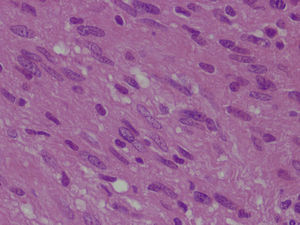 Schwannoma (detalle) mostrando celularidad con ausencia de hipocromasia y apariencia homogénea. Hematoxilina-eosina 40×.