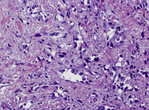 (HE x200) Angiosarcoma de mama de grado intermedio. Tumoración constituida por múltiples canales vasculares anastomosados tapizados por endotelio con atipia moderada-severa y frecuente extravasación hemática.