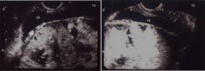 Se observa pérdida de la interfase coriomiometrial (IN) con ausencia de tejido miometrial en la base de la inserción placentaria, infiltración por vasos prominentes (VP) al doppler color en la pared posterior de la vejiga (VE) sin que se evidencie en la imagen masa exofítica. Espacios lacunares (L) prominentes en la placenta (P), hallazgos altamente sugestivos de placenta percreta.