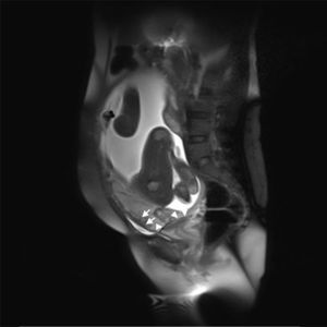 Secuencia sagital potenciada en T2. Se observa pérdida de la interfase normal entre placenta y miometrio con tejido placentario que penetra la totalidad de la pared uterina (flechas). Hematoma retroplacentario sobre el orificio cervical interno (cabeza de flechas).