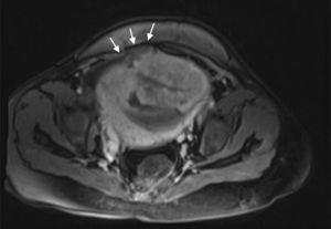 Secuencia axial potenciada en T1 con medio de contraste intravenoso. Se observa pérdida de la interfase normal placenta-miometrio con irregularidad del contorno uterino (flechas).