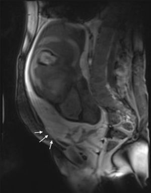 Secuencia sagital potenciada en T1 con medio de contraste intravenoso. Se observa pérdida de la interfase normal placenta-miometrio con irregularidad del contorno uterino (flechas). Se visualiza hematoma retroplacentario.