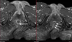 Esta paciente muestra una trayectoria fistulosa desde la pared posterior del ano, caudal al músculo elevador, con extensión cutánea hasta la región interglútea paramedial dcha.