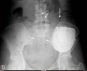 Radiografía AP simple de pelvis para mostrar electrodos de estimulación, raíces sacras y catéter intratecal.