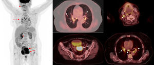 Estadificación de cáncer de cérvix. Paciente de 72 años con carcinoma escamoso de cuello uterino con invasión parametrial y de la vagina y el cuerpo endometrial, sin adenopatías locorregionales detectadas mediante RM. Imagen de cuerpo entero de PET (izquierda) e imágenes de fusión PET-TC axiales que muestran la tumoración primaria cervical, retrovesical (flecha), que condiciona hidronefrosis derecha (asterisco), sin adenopatías locorregionales. Sin embargo, se evidenciaron adenopatías mediastínicas (flecha discontinua), laterocervical izquierda (flecha corta) y nódulos pulmonares (estrellas), que suponen un estadio IV.