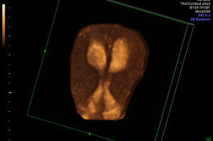 Imagen de ecografía 3D de la primera paciente: septo uterino completo y doble cérvix.