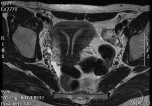 Imagen de RMN de la segunda paciente que nos ayuda a confirmar el diagnóstico realizado por ecografía: septo uterino completo y doble cérvix.