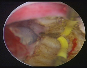 Imagen realizada durante la histeroscopia. Observamos el septo uterino parcialmente resecado y cómo asoma la sonda de Foley por la izquierda.
