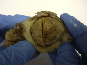 Nódulo de la hermana María José. Imagen macroscópica. Se observa un nódulo focalmente ulcerado en superficie.