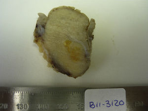Nódulo de la hermana María José. Imagen macroscópica. La superficie de corte del nódulo tumoral muestra un aspecto fasciculado y una tonalidad blanquecina, con focos amarillentos.