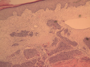 Nódulo de la hermana María José. En la imagen histológica se observa cómo nidos neoplásicos de fenotipo escamoso ocupan la dermis sin alcanzar la epidermis (HE, ×40).