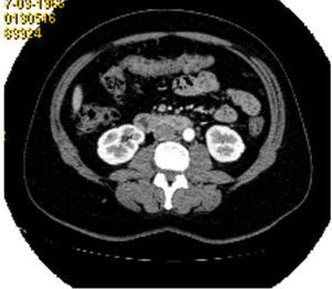 Tomografía computarizada abdominopélvica. Lesión sólida de ovario derecho.