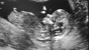 Feto masculino con tubérculo genital con ángulo superior a 30°.