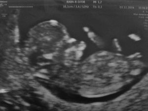 Feto femenino con tubérculo genital paralelo o convergente (ángulo inferior a 30°).