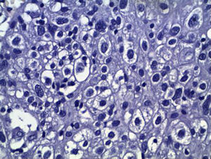 Carcinoma de células claras del ovario. Hipercromasia nuclear y aspecto vacío del citoplasma.