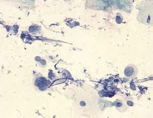 Células atípicas de núcleos grandes con cromatina tosca. Estiramientos cromatínicos y restos nucleares en el fondo. Papanicolaou ×660.