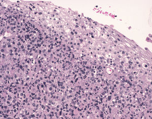 Epitelio escamoso normal en la superficie y por debajo una proliferación atípica y difusa. Se observan núcleos grandes, excéntricos y nucléolo prominente. Hematoxilina-eosina ×100.
