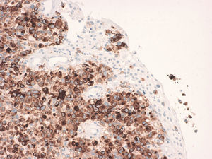 Se aprecia epitelio escamoso negativo y la proliferación atípica positiva en el citoplasma. Un grupo invade el epitelio de superficie (invasión pagetoide). MelanA ×200.