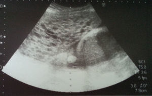 Placenta mola adherida a la cara lateral derecha del útero, visualizada a las 16 semanas de gestación