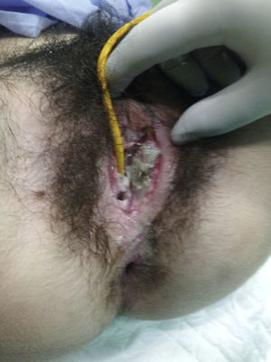 Imagen de la úlcera en el quirófano, antes de proceder a la intervención.