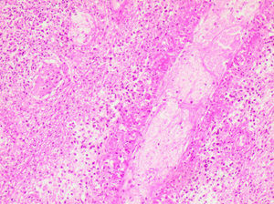Imagen microscópica de la pieza de biopsia.