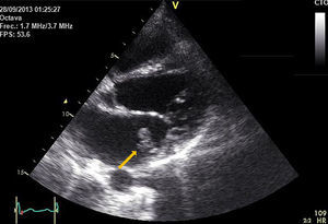 Ecocardiografía transesofágica que muestra vegetación sobre el velo posterior de la válvula mitral (flecha).