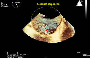 Ecocardiografía transesofágica tridimensional que muestra vegetación sobre la válvula mitral (flecha).