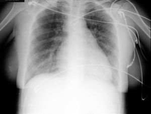 Radiografía de tórax (proyección anteroposterior).