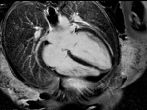 Resonancia magnética nuclear cardiaca (corte transversal).