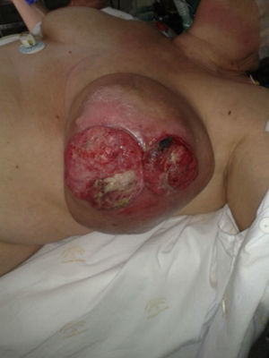 Aspecto macroscópico de la mama antes de la intervención.